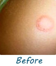 ringworm how to get rid of